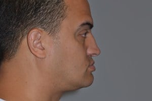 Patient with short upper jaw - before, front view