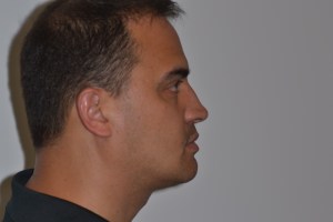 Patient with short upper jaw - after, front view