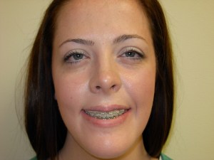 Patient with long upper jaw and retruded lower jaw - after, front view