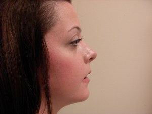 Patient with long upper jaw and retruded lower jaw - after, side view