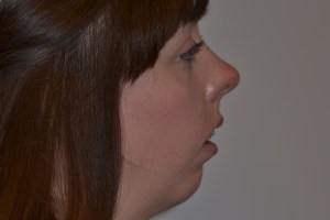 Patient with long upper jaw and retruded lower jaw - before, side view