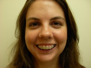 Patient with long upper jaw - before, front view