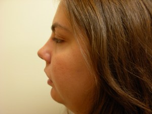 Patient with long upper jaw - before, side view