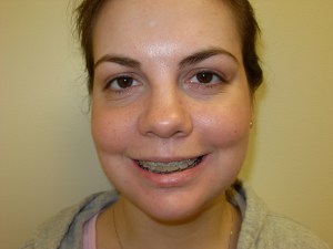 Patient with long upper jaw - after, front view