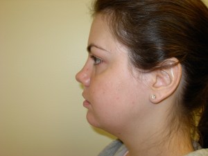 Patient with long upper jaw - after, side view