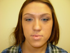 Patient with retruded upper jaw and protruded lower jaw - before, front view