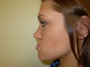 Patient with retruded upper jaw and protruded lower jaw - before, side view