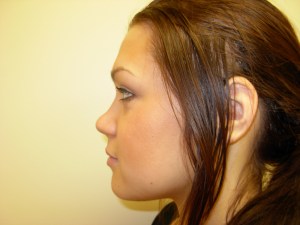 Patient with retruded upper jaw and protruded lower jaw - after, side view