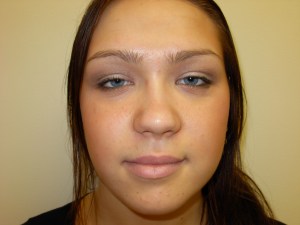 Patient with retruded upper jaw and protruded lower jaw - after, front view