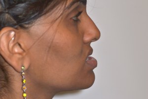 Patient with retruded upper jaw and protruded lower jaw - before, side view