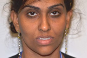 Patient with retruded upper jaw and protruded lower jaw - before, front view