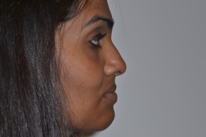 Patient with retruded upper jaw and protruded lower jaw - after, side view