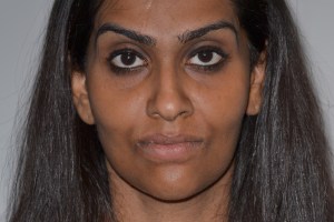 Patient with retruded upper jaw and protruded lower jaw - after, front view