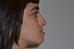 Patient with retruded upper jaw and protruded lower jaw - before, side view