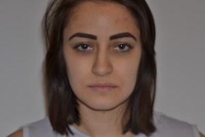 Patient with retruded upper jaw and protruded lower jaw - after, front view