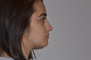 Patient with retruded upper jaw and protruded lower jaw - after, side view