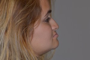 Patient with short upper jaw - before, side view
