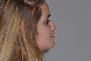 Patient with short upper jaw - after, side view