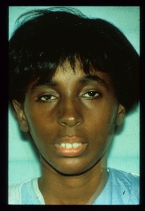 Patient with long upper jaw and retruded lower jaw - before, front view