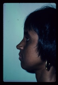 Patient with long upper jaw and retruded lower jaw - after, side view