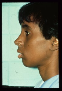 Patient with long upper jaw and retruded lower jaw - before, side view