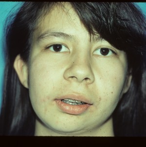 Patient with facial asymmetry - before, front view