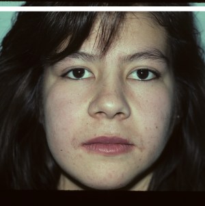 Patient with facial asymmetry - after, front view