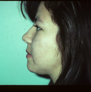 Patient with facial asymmetry - after, side view