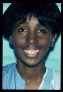 Patient with long upper jaw and retruded lower jaw - before, front view