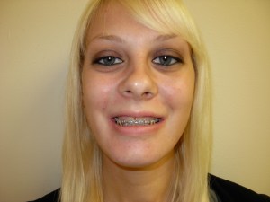 Patient with long upper jaw - after, front view