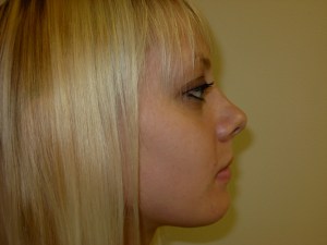 Patient with long upper jaw - after, side view