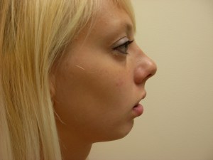 Patient with long upper jaw - before, side view