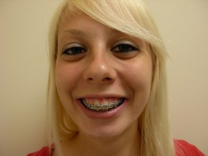 Patient with long upper jaw - before, front view