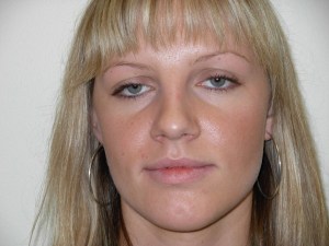Patient with retruded upper jaw - after, front view
