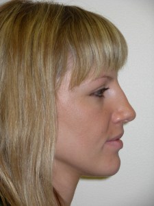Patient with retruded upper jaw - after, side view