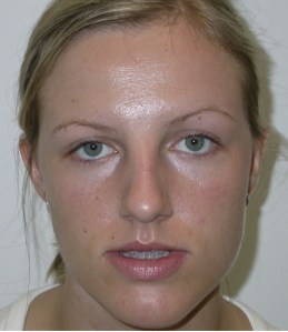 Patient with retruded upper jaw - before, front view