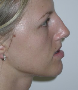 Patient with retruded upper jaw - before, side view