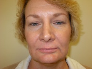 Patient with the lower jaw back and chin too forward - before, front view