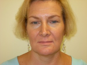 Patient with the lower jaw back and chin too forward - after, front view