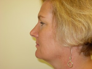 Patient with the lower jaw back and chin too forward - after, side view